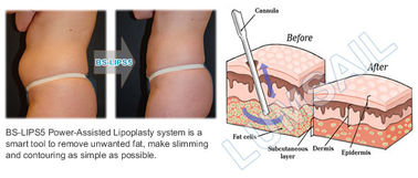 Il potere di contorno del corpo ha assistito l'attrezzatura della liposuzione per il corpo che scolpisce i trattamenti