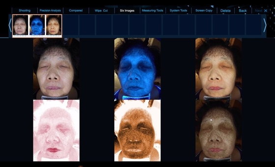 Lo spettro 6 vede l'attrezzatura facciale più chiara dell'analisi della pelle di problema di pelle