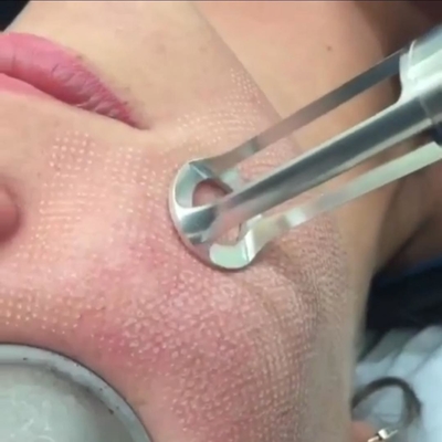 Macchina chirurgica del laser della cicatrice dell'acne frazionaria portatile di CO2 15w