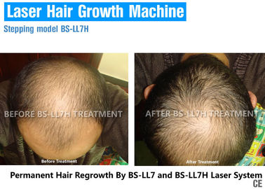 Dispositivo indolore di ricrescita dei capelli del laser a diodi con la terapia di ringiovanimento dei capelli per perdita di capelli